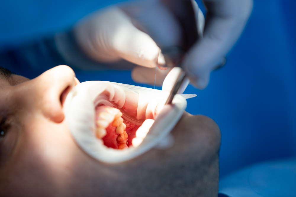 Dental Crowns