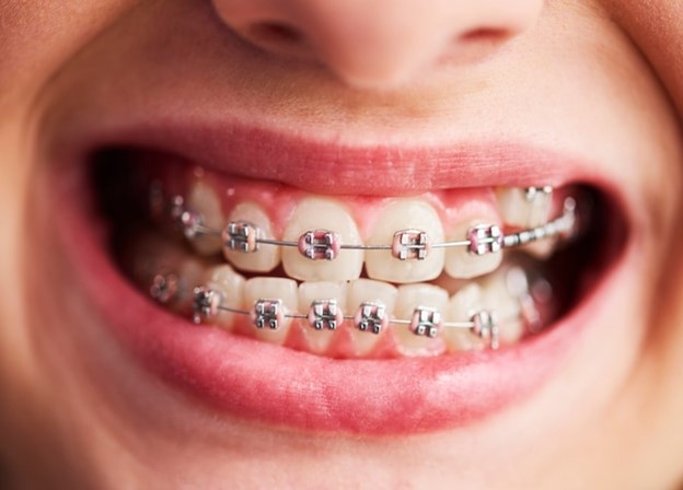 Braces in Long Beach